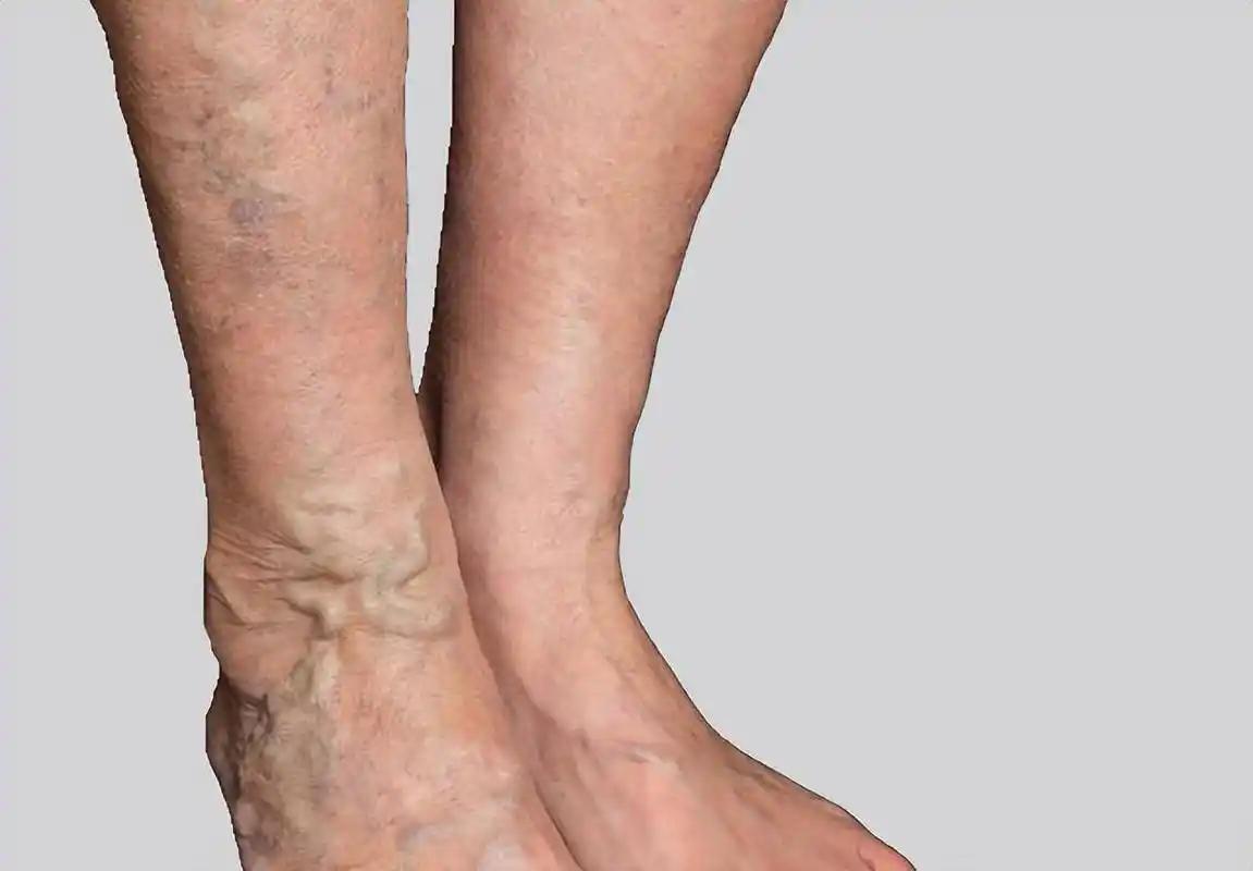 开云体育入口-女子因肺栓塞不幸走了！医生：天冷宁愿躺一天，也别干这5事！