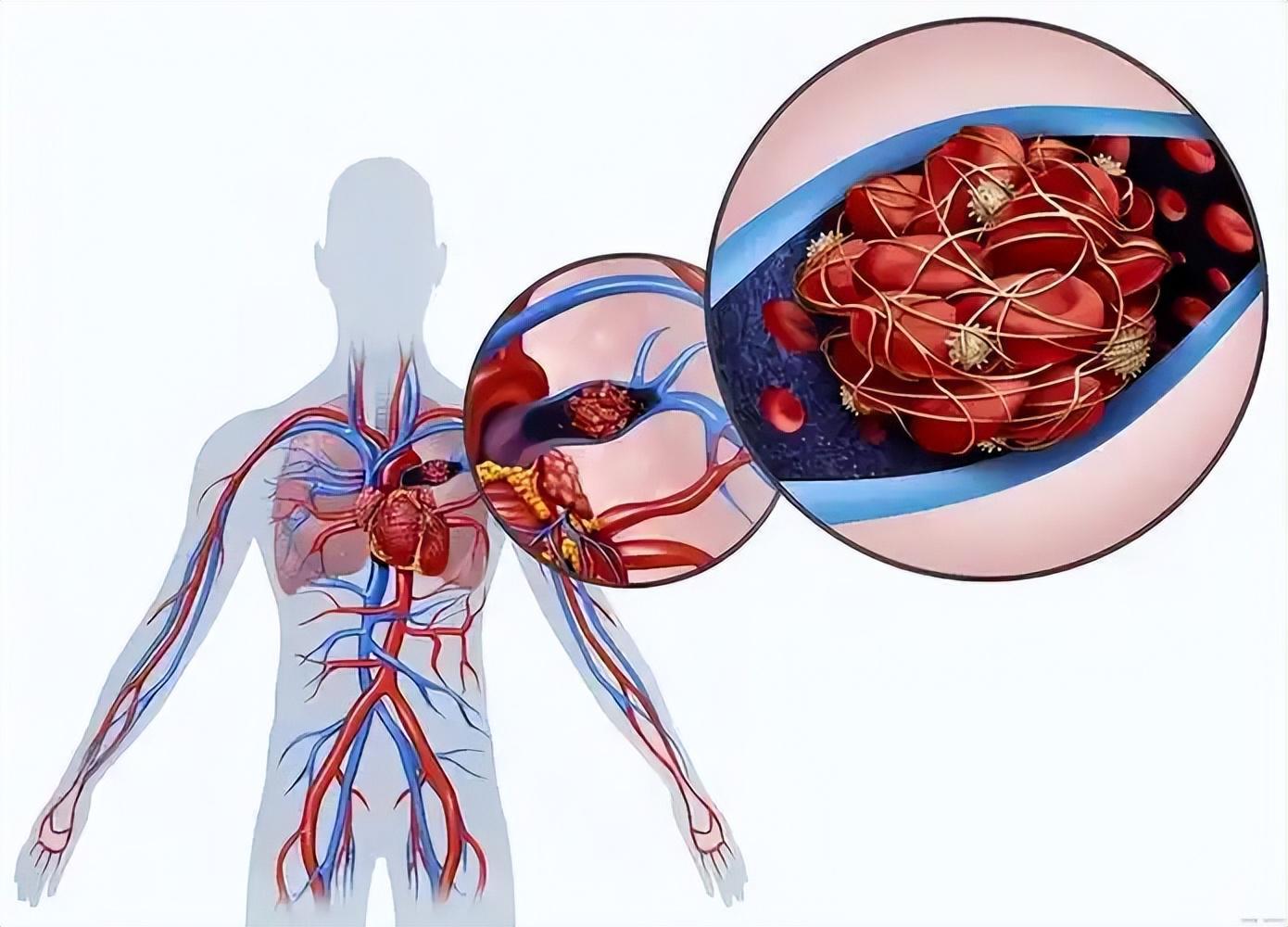 开云体育入口-女子因肺栓塞不幸走了！医生：天冷宁愿躺一天，也别干这5事！